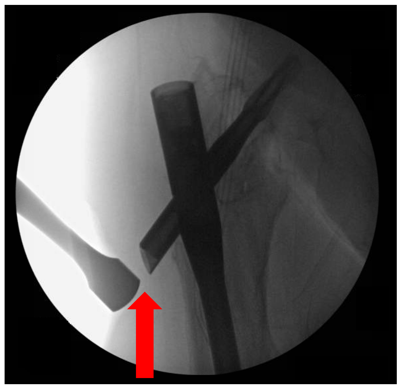 PDF) Locked intramedullary nailing for the treatment of femoral shaft  fractures: experience and result in 19 cases