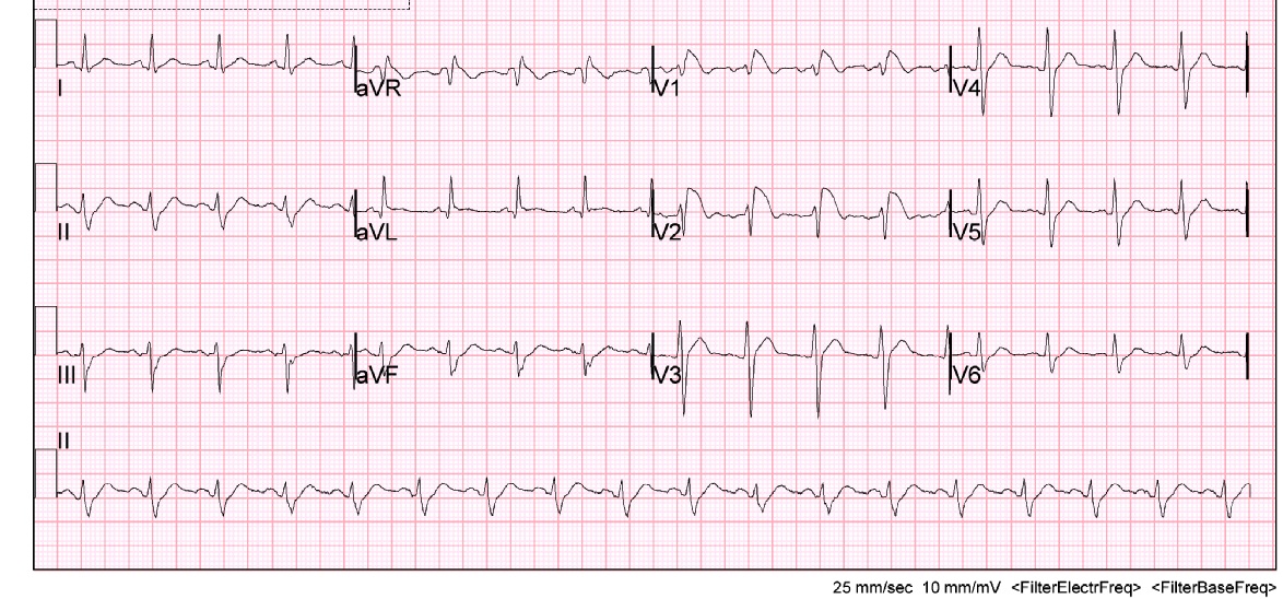 Malignant Dysrhythmias – Brugada Type 1 Pattern Formation in the ...