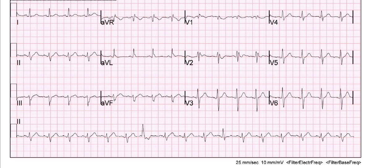 Malignant Dysrhythmias – Brugada Type 1 Pattern Formation in the ...