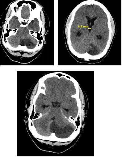 Posterior Inferior Cerebellar Infarct in a Younger Adult Male with ...
