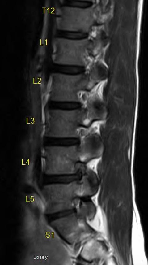 Lumbar spine protocol (MRI), Radiology Reference Article